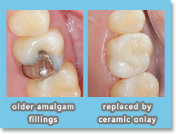 Comparing with other materials, ceramics resemble a tooth’s color the most. For its excellent aesthetic appearance and sufficient strength, ceramic inlay/onlay becomes more and more popular among dentists and patients