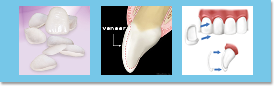 veneer is a minimally invasive prosthetic method used at Paul Dental Clinic