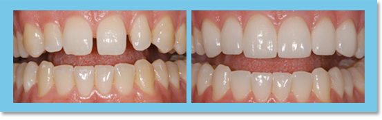 Malformation of front teeth or dentural diastema (the open area between adjacent front teeth) presents an unattractive appearance, but with very little preparation of the related tooth, veneer can restore the normal tooth shape and contact area.