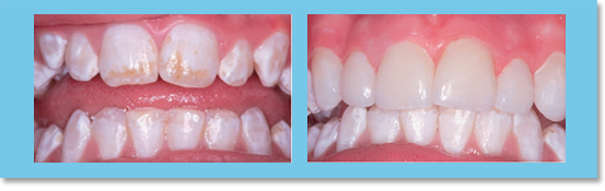 Fluorosis is a condition that can cause molting and discoloration of enamel tissue. The mottled enamel can be covered by aesthetic veneer.