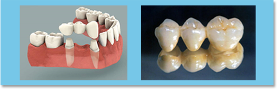 If the missing teeth are not too many, the adjacent teeth can act as abutments, being cemented with fixed a bridge