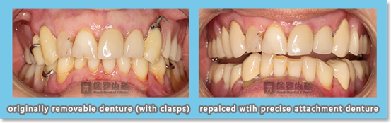 comparison between removable denture and Precise Attachment Denture