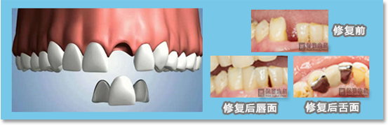 主要用于前牙区，如果不想采用种植牙修复，又不想制作固定桥，因为担心磨除大量天然牙齿组织对牙齿伤害较大，可以考虑马里兰桥的方式