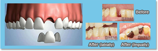 a Maryland Bridge is used to replace anterior teeth and is cemented directly to the adjacent teeth with little preparation