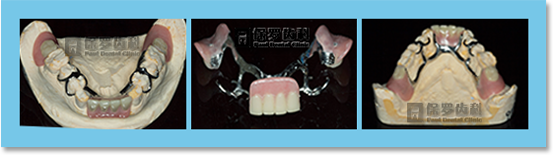 Complete Denture