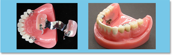 Precise Attachment Denture at Paul Dental