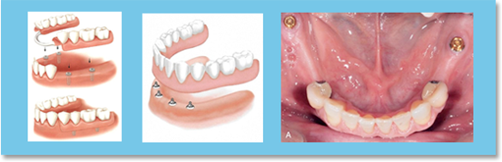 When prosthodontic appliances do not fit properly or are difficult to retain in the mouth, titanium implants may be suggested by the dentist to provide stabilization and retention.