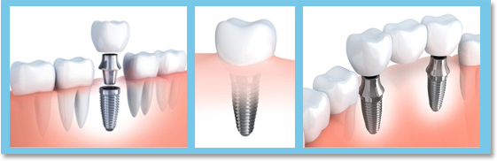 Implantation at Qingdao paul dental clinic is comfortable, painless and durable