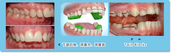 功能性矫治器（如Twin blocks）进行初期矫正，引导下颌骨向前发育