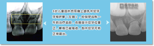 常见的牙齿外伤有牙齿折裂、移位、嵌入、脱出。患者应及时就近就诊，根据情况固定或拔出以保护下方恒牙胚