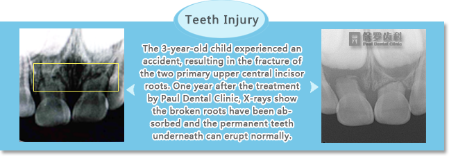 Primary Teeth Injury treated at qingdao paul dental clinic