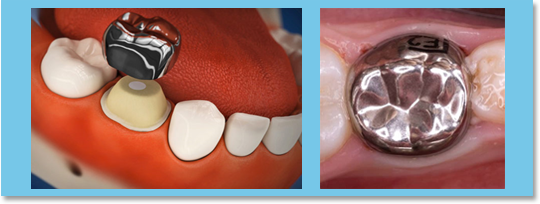 Badly decayed or broken-down milk teeth, that cannot be restored with filling, need to receive a straight edge or contoured stainless steel crown.