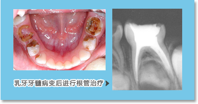 乳牙牙髓解剖结构异于恒牙，丰富的经验、正确的判断是保证治疗成功的前提；充填使用可吸收材料，不影响恒牙萌出