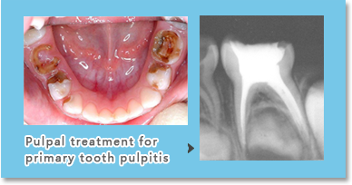 If the cavity has affected the pulp, the inflamed pulp needs to receive pulpal treatment