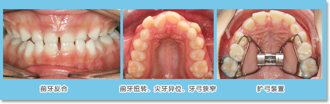 主要应用于前牙反合，前牙扭转，尖牙异位，牙弓狭窄等情况，纠正错误咬合关系、萌出位置、角度，扩大牙弓等