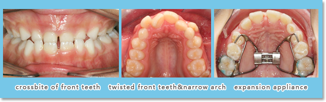 Early fixed or removable orthodontics is mainly used in conditions like anterior crossbite, rotation of front tooth, canine displacement, narrow arch and so forth