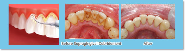 Subgingival Debridement is to remove subgingival plaque and calculus through root-surface scaling and root planning