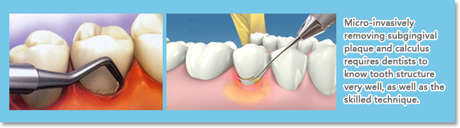 Supragingival Debridement (Teeth cleaning) aims to remove supragingival plaque, calculus, and stain through tooth-crown scaling