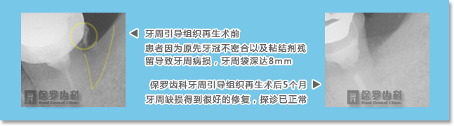 青岛保罗齿科使用GTR牙周引导性组织再生术修复缺损牙周组织