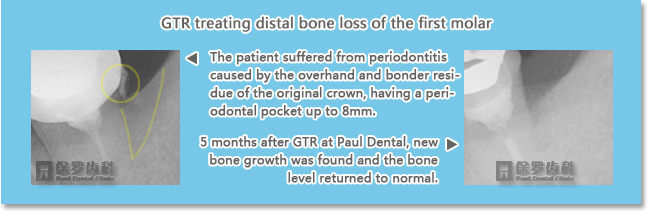 paul dental clinic uses GTR to restore and adjust the marginal ridge, encouraging the growth of new periodontal attachment