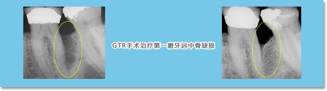 青岛保罗齿科牙周引导性组织再生术