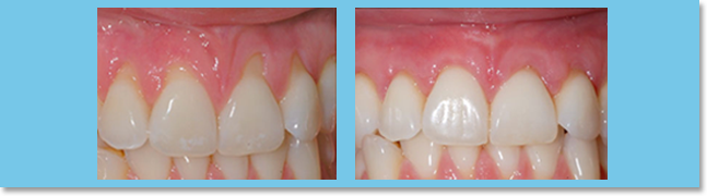 Soft tissue grafting helps to restore the gingival crest to a natural height