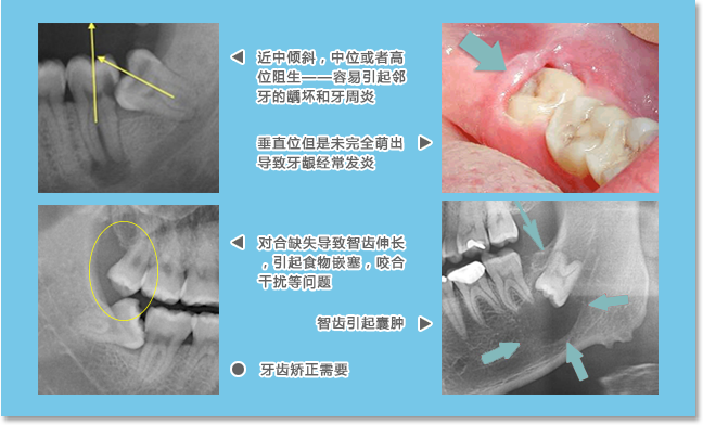 图片情况的智齿需要拔除