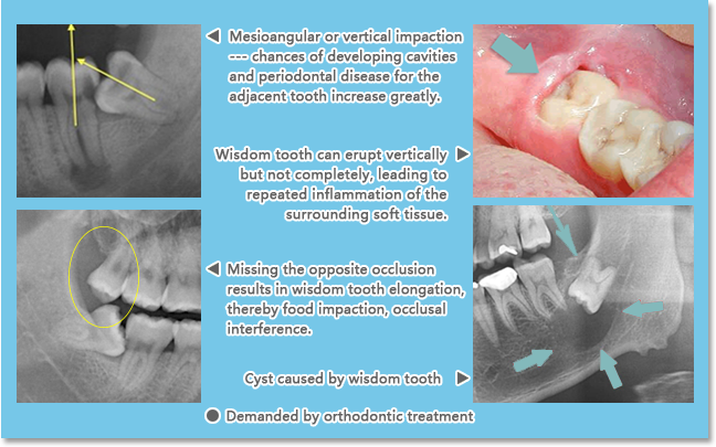 Wisdom teeth need to be extracted in the following situations