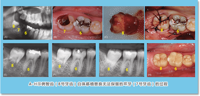 牙齿移植是将智齿植入拔除的磨牙窝