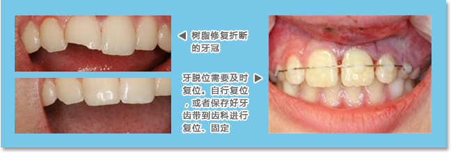 保罗齿科固定外伤的牙齿长期疗效好