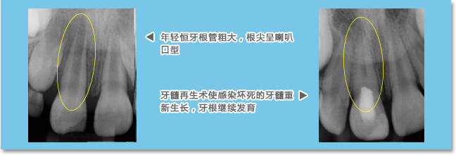 牙髓再生治疗让感染坏死的牙髓重新生长，牙根继续发育