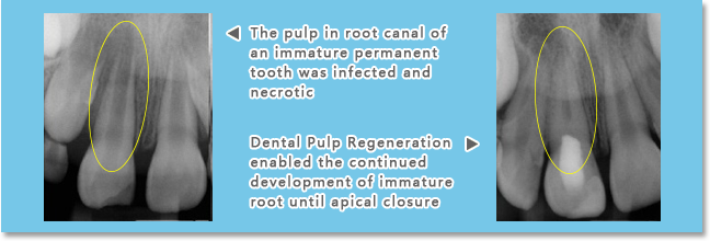 if those immature necrotic permanent teeth can receive biologically based endodontic therapies in time, root development will continue --- dentinal wall thickness will increase, and apical closure will be achieved