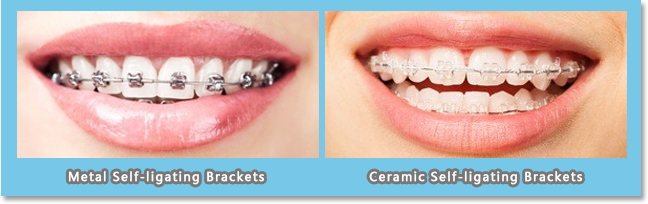 metal self-ligating brackets and ceramic self-ligating brackets