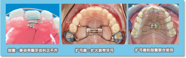 扩弓器加指簧可联合扩大狭窄牙弓，简单纠正个别牙齿不齐