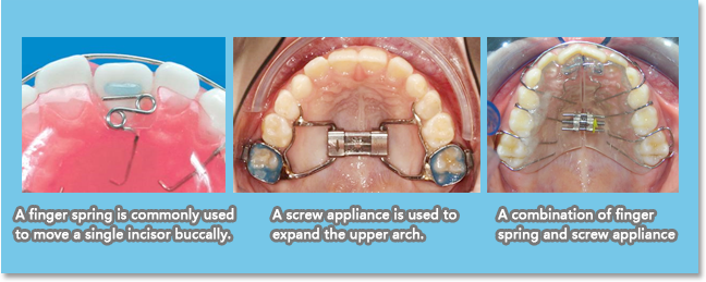 Removable appliances are fabricated mainly in acrylic and wire, and can be removed from the mouth by the patient