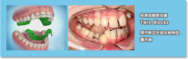 青岛保罗齿科使用twin blocks经典功能矫正器引导骨骼和牙齿发育