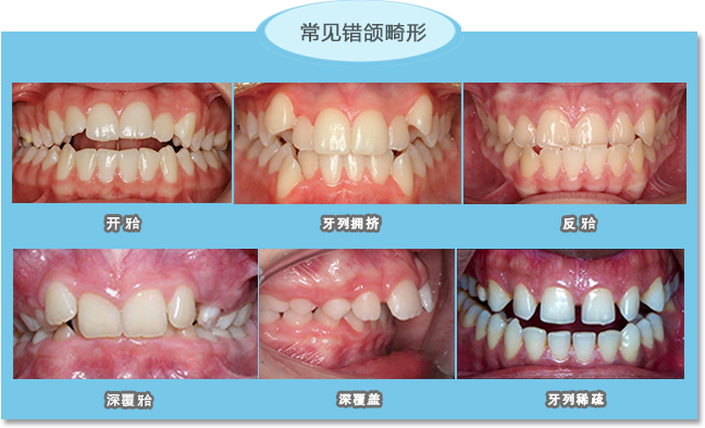 几种常见错颌畸形
