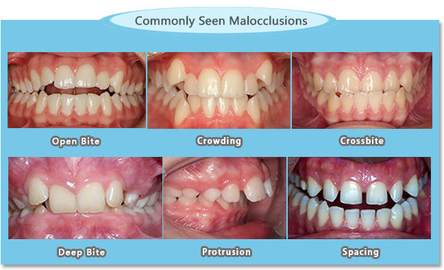 some commonly seen malocclusions