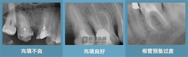 根管充填不良与根管充填过度均不能达到青岛保罗齿科恰充的长期良好效果