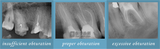 comparision of obturation at Paul Dental with at other dental clinic