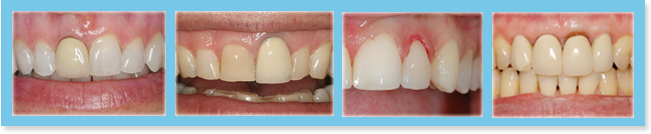 Rough prosthesis looks frustrating and can cause periodontal, endodontic and biting problems