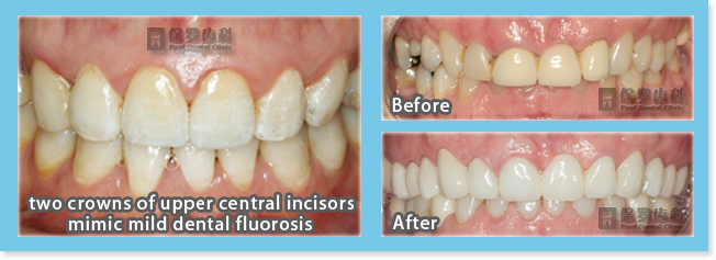 Fine prosthesis of front teeth by Paul Dental Clinic