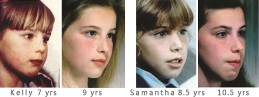 comparison of Kelly and Samantha on mouth breathing