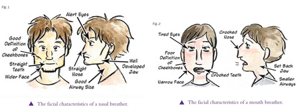 the comparison of the facial characteristics of nasal and mouth breather are as follows