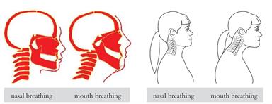 Distally shifted tongue positions result in a further restriction of the airway