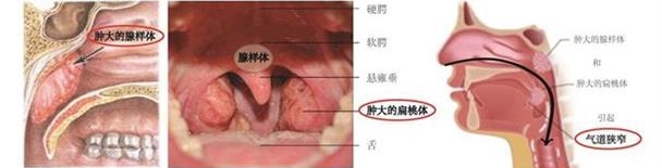 腺样体扁桃体肥大