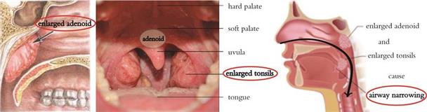 Hypertrophied palatine tonsils or adenoids