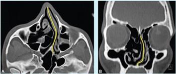 CT shows nasal septum deviation obstructing the airway passage through the nostrils