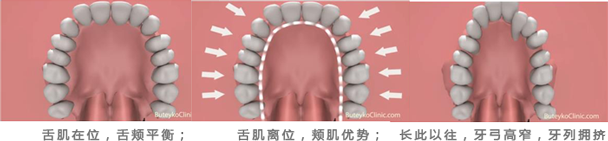 口呼吸口周肌肉不平衡