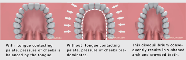 The natural development of the upper teeth is disturbed, leading to malaligned or crooked teeth, or even, posterior crossbite.